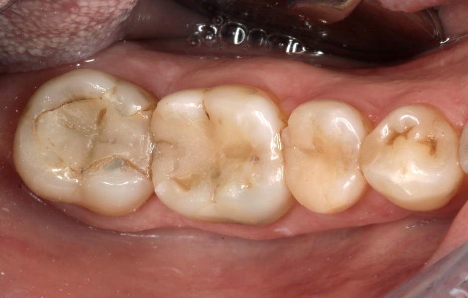 Obr. 3a: Nevyhovující výplně zubů 46 a 47.