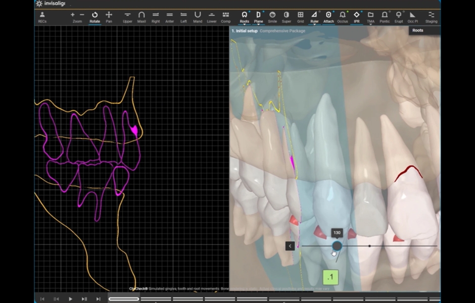 Obr. 3: Integrace CBCT do softwaru ClinCheck přináší vylepšenou vizualizaci a přesnost u složitých ortodontických případů.