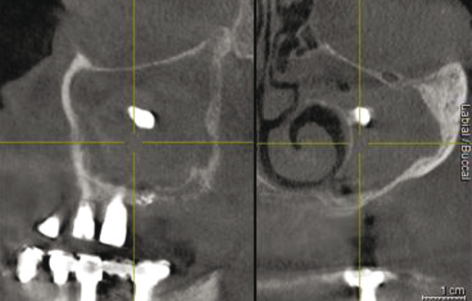 Obr. 1: CBCT: radiopakní stín v levém maxilárním sinu.