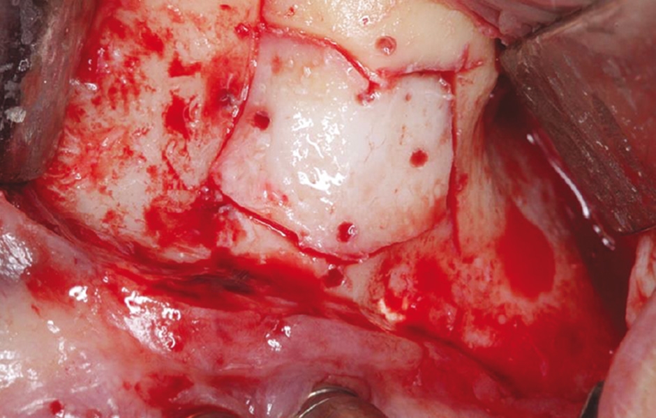 Obr. 2: Vytvoření kostního okénka mikropilkou včetně perforací pro fixaci resorbovatelnými stehy.