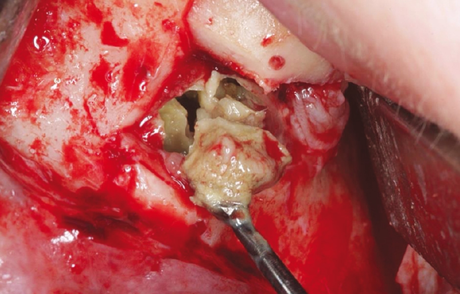 Obr. 3: Po vyjmutí kostěné lamely byla patrná zelenošedá masa; histologie potvrdila aspergilom.