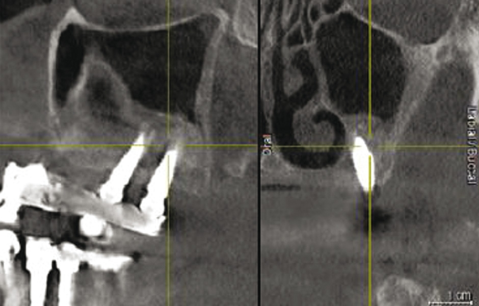Obr. 6: CBCT po 10 letech od augmentace a zavedení implantátů ukazuje oblast bez recidivy.