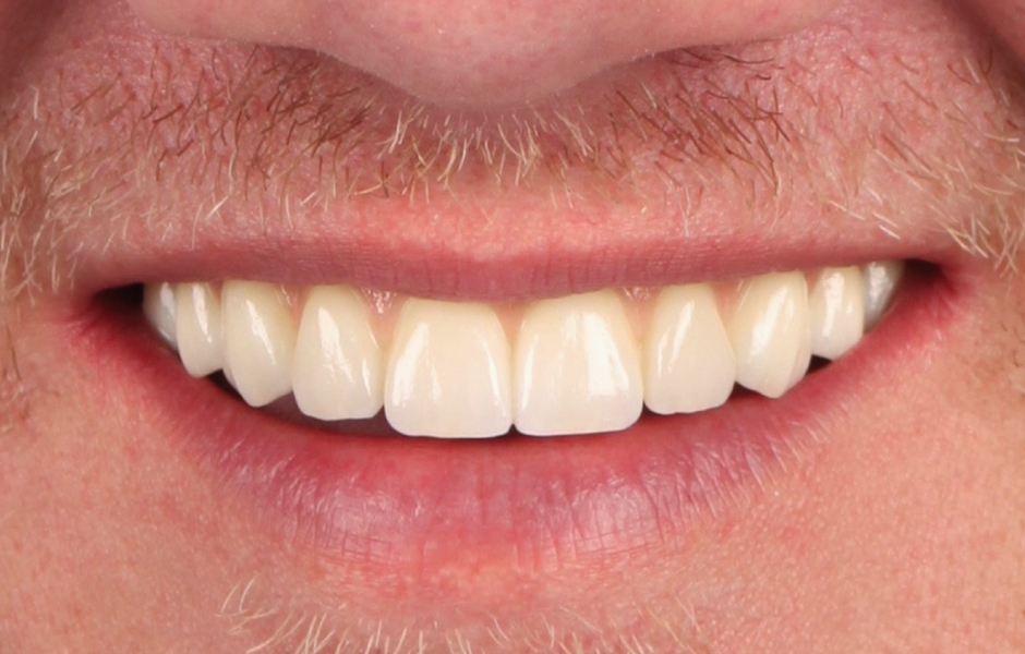 Obr. 10: Definitivní náhrada v ústech pacienta.