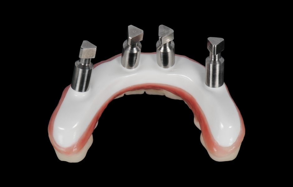 Obr. 6: Definitivní náhrada vyrobená výhradně ze zirkonie pro maximální pevnost, estetiku a dlouhodobou stabilitu.