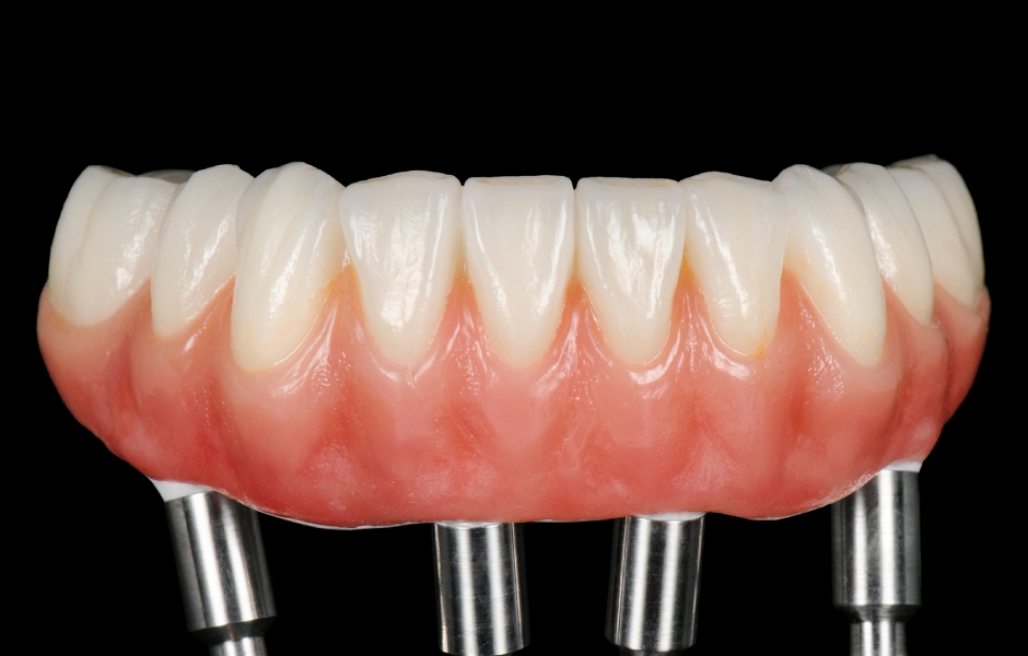 Obr. 7: Definitivní náhrada vyrobená výhradně ze zirkonie pro maximální pevnost, estetiku a dlouhodobou stabilitu.