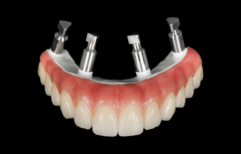 Obr. 8: Definitivní náhrada vyrobená výhradně ze zirkonie pro maximální pevnost, estetiku a dlouhodobou stabilitu.