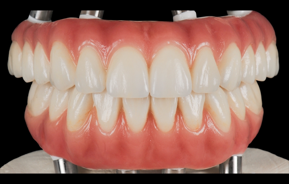 Obr. 9: Definitivní náhrada vyrobená výhradně ze zirkonie pro maximální pevnost, estetiku a dlouhodobou stabilitu.