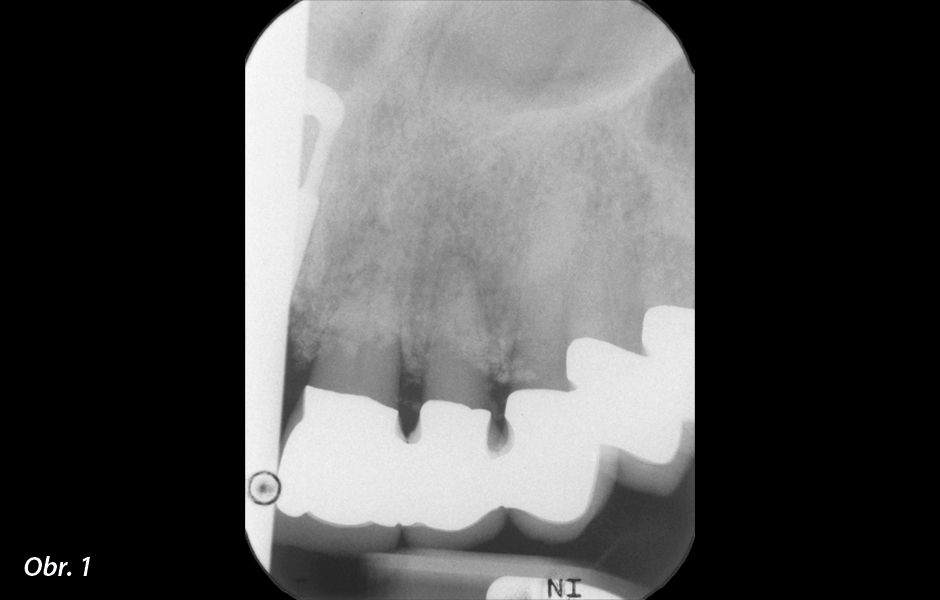 Počáteční nálezy na RTG snímku odhalily řadu korunkových náhrad vyžadujících výměnu. Při odstraňování náhrady došlo k nechtěné extrakci zubů 21 a 22.