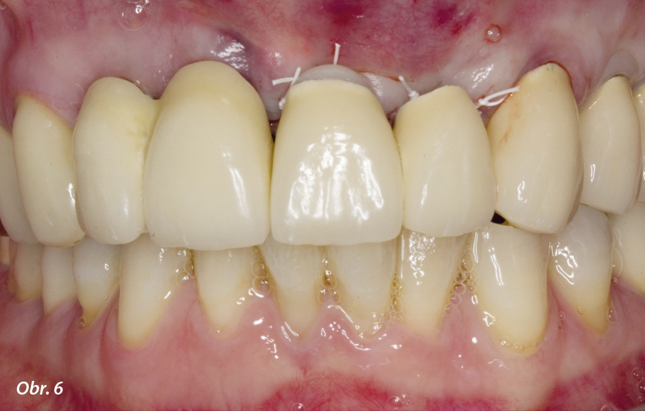 Situace po implantaci a augmentaci: Starý můstek byl nasazen zpět jako provizorní náhrada na dobu fáze hojení, přičemž v místě implantátu v oblasti zubu 22 byl mezičlen obroušen tak, aby jen volně dosedal.