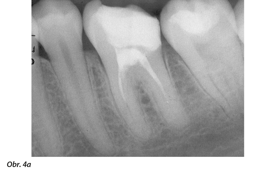 Výplně bez čepů nebo korunky u kazem značně zasaženého prvního moláru. Situace na RTG snímku (a) 