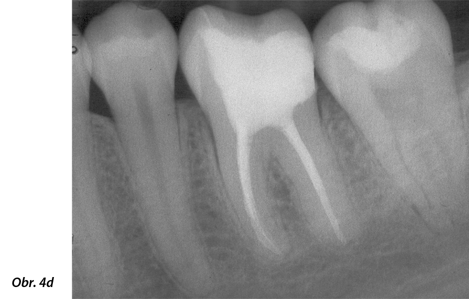 Radiologická (d) situace po umístění nepřímé onleje z kompozitní pryskyřice. 