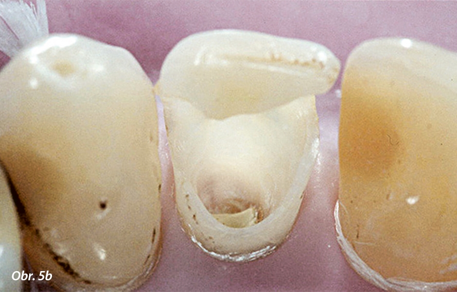 Dlouhodobé sledování případu postranního řezáku neošetřeného ani čepem ani korunkou. Počáteční stav v roce 1994 (a, b). Zub 12 je devitalizovaný, diskolorovaný a vykazoval značně velký kaz (b).