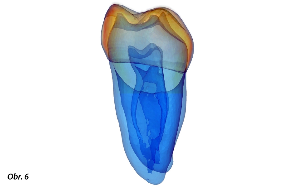 Přirozené zuby je možno použít jako databanku v podobě stereolitografických složek, které umožňují trojrozměrný náhled na protetické struktury