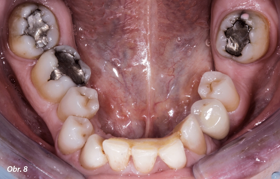 Pohled na okluzální plošky horních a dolních zubů