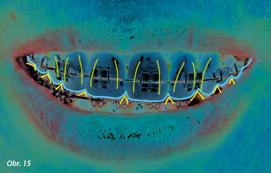 Asymetrie okluzní roviny a os zubů ve vztahu k horizontální a bipupilární linii byla napravena během ortodontické léčby