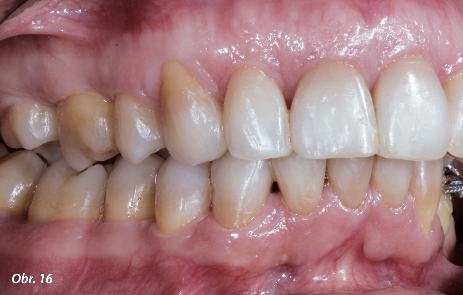 Konec ortodontické léčby: bylo dosaženo vyhovujícího uspořádání horních frontálních zubů – to umožnilo pokračovat bez dalších protetických zákroků