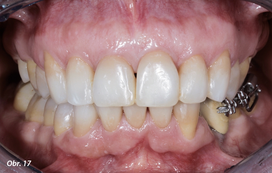 Konec ortodontické léčby: bylo dosaženo vyhovujícího uspořádání horních frontálních zubů – to umožnilo pokračovat bez dalších protetických zákroků