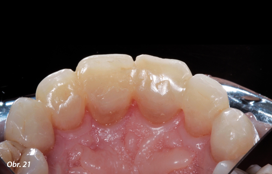Dlahování skelnými vlákny a kompozitem za účelem udržení výsledku ortodontické léčby