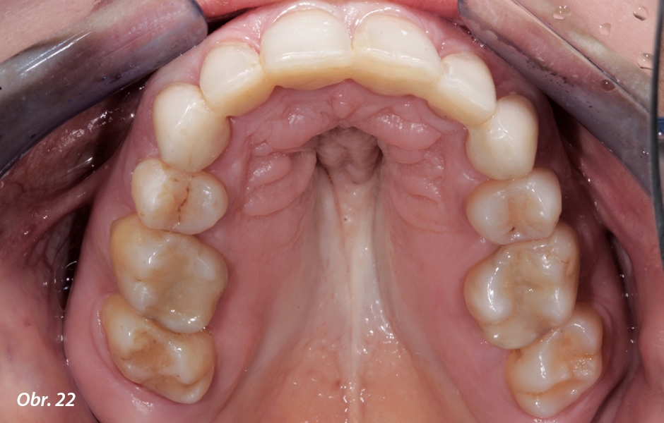 Konec ortodontické léčby: postavení zubů v horní a dolní čelisti