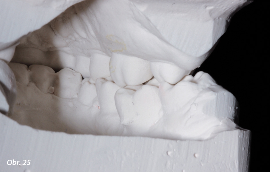 Pohled na okluzi modelů použitých k analýze po ortodontické léčbě