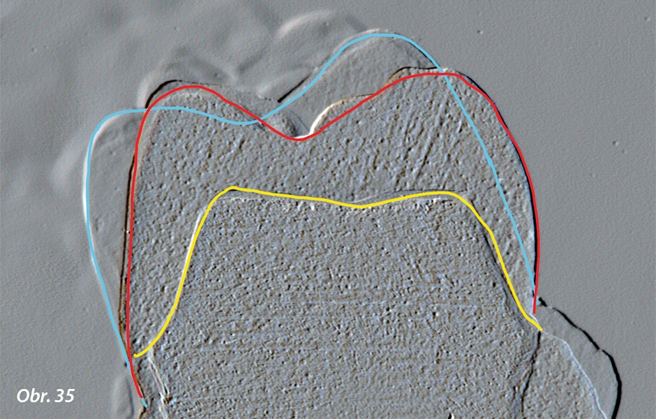 Realizace navržené korunky s preparací řízenou indikacemi diagnostického wax–upu, který maximálně zachovává zdravé zubní tkáně