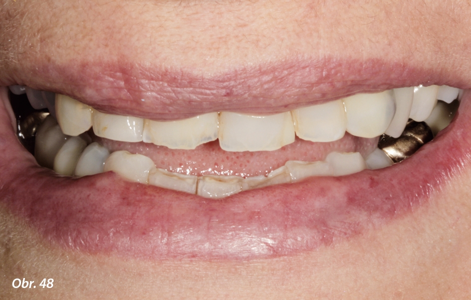 U pacientky jsme diagnostikovali řadu erozivních lézí korunek zubů, které změnily jejich tvar a také linii úsměvu s následky na fonaci, a byl proto zapotřebí terapeutický protetický zákrok