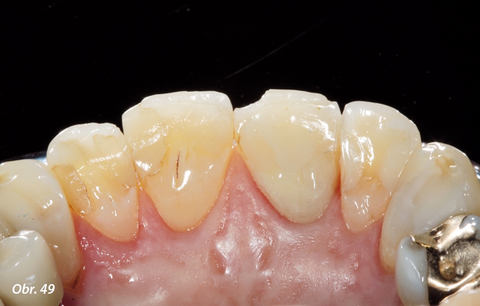 U pacientky jsme diagnostikovali řadu erozivních lézí korunek zubů, které změnily jejich tvar a také linii úsměvu s následky na fonaci, a byl proto zapotřebí terapeutický protetický zákrok