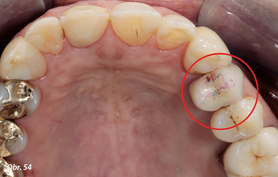 Na konci diagnostické fáze jsme si označili předčasné kontakty mezi mezio-okluzální stěnou zubu 24 a distálním růžkem zubu 33