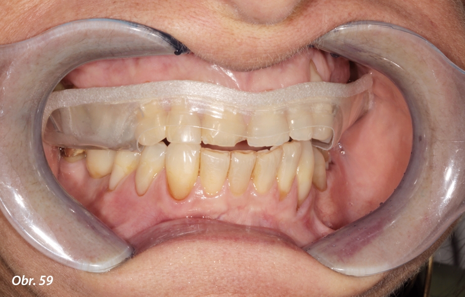 Před zaznamenáním centrálního vztahu jsme upravili špatné podmínky v ústech pacientky – jako pomocný prostředek pro uvolnění svalů jsme použili systém Acqualizer®