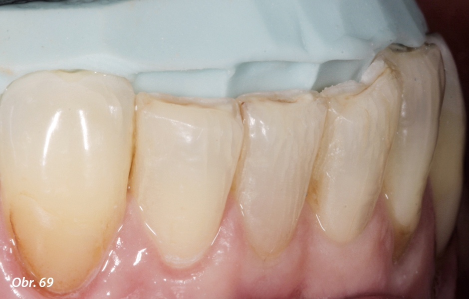Pryskyřičné náhrady se nacementují v zubní ordinaci