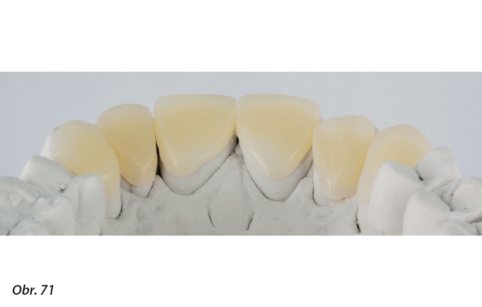 Pryskyřičné prvky přizpůsobíme a překryjeme disilikátovými protetickými rekonstrukcemi, stále bez provedení jakékoli preparace povrchu zubů