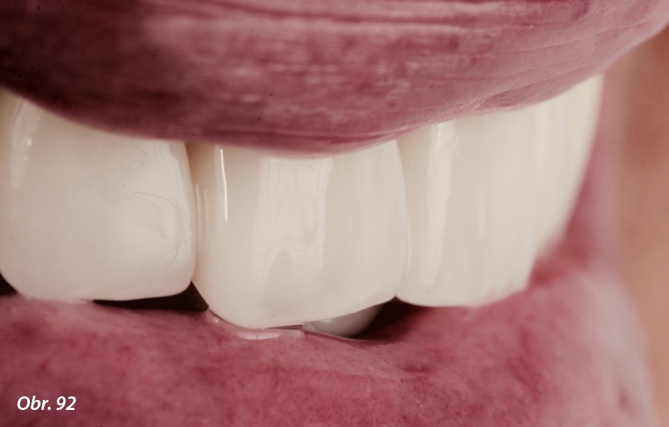 Rekonstrukce korunek umožňuje obnovit délku incizálního okraje a vytvořit harmonii zubů a rtů
