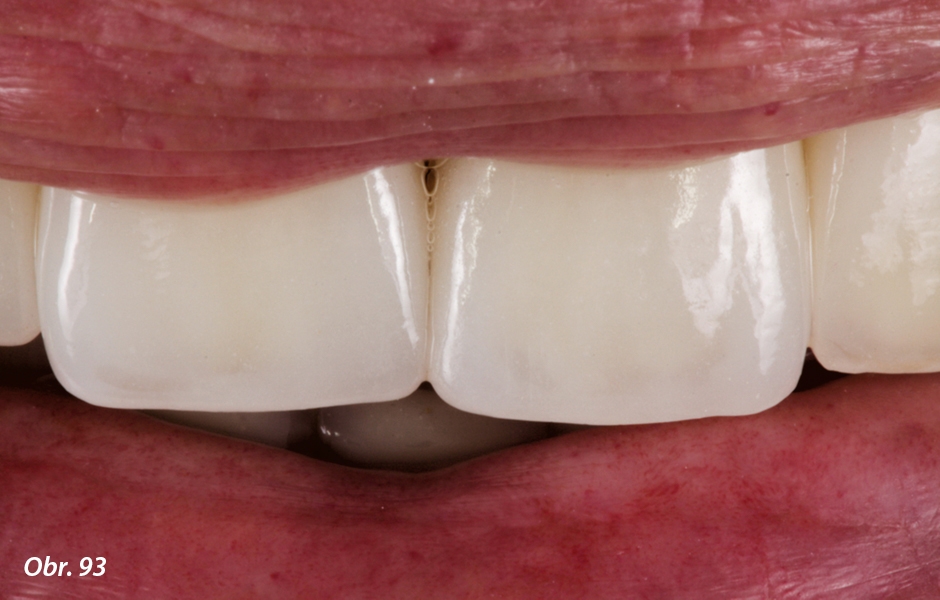 Rekonstrukce korunek umožňuje obnovit délku incizálního okraje a vytvořit harmonii zubů a rtů