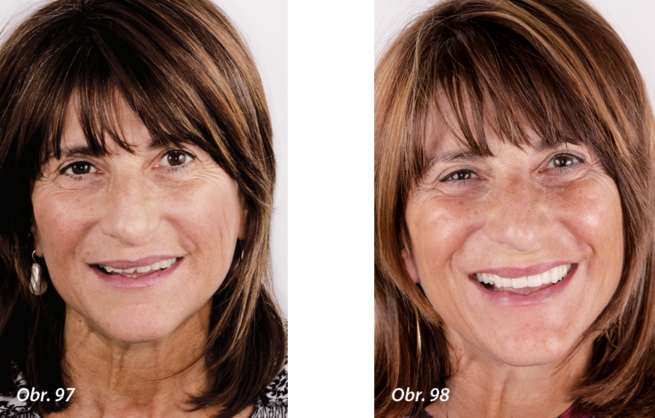 Estetika obličeje a úsměvu pacientky před a po ošetření