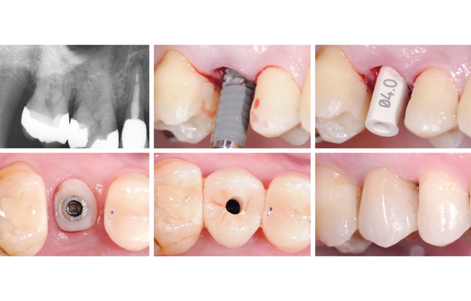 Původní situace • Okamžitá implantace po extrakci zubu • Skenovací abutment pro digitální otiskování • Provizorní náhrada • Definitivní náhrada před uzavřením malého přístupového kanálu ke šroubku • Boční pohled na definitivní náhradu