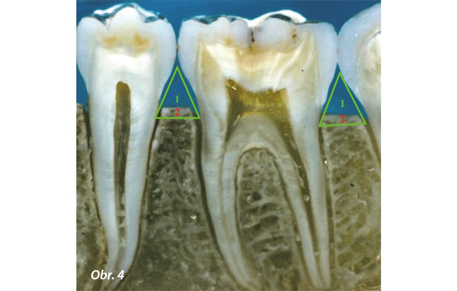 Vertikální řez alveolárního procesu: 1 – výběžek dásňové papily, 2 – cílový bod intraseptální anestezie