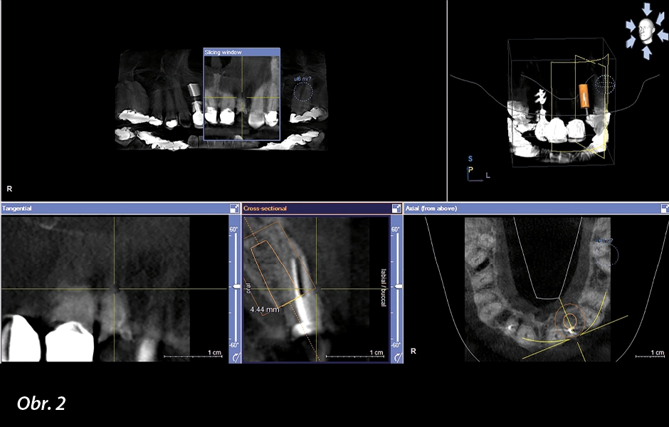 CBCT sken před ošetřením a plánování implantátu