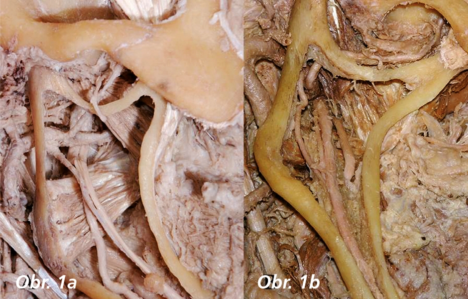 Obr. 1: Anatomické variácie temporomandibulárneho kĺbu (TMK)  a: Temporomandibulárny kĺb so zachovaním topografie okolitých štruktúr  b: Špecifický tvar processus condylaris mandibulae – proliferatívne zmeny hlavice kĺbu v tvare pripomínajúcom hubu