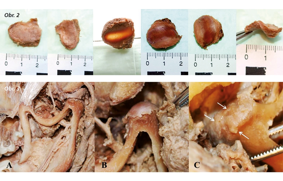 Obr. 2: Discus articularis. Anatómia a morfometrické parametre. Veľkosť a hrúbka znázornená meradlom. Disk predstavuje pomerne hrubá bikonkávna platnička alebo ho tvorí iba tenká väzivová, perforovaná vrstva.  Obr. 3: Zmeny TMK v procese starnutia – fyzio