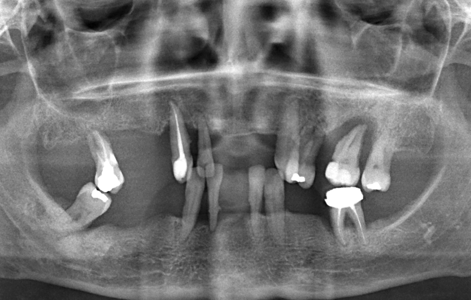 Obr. 1: OPG výchozího stavu chrupu a parodontu: výrazné resorptivní změny a úbytek alveolární kosti. 