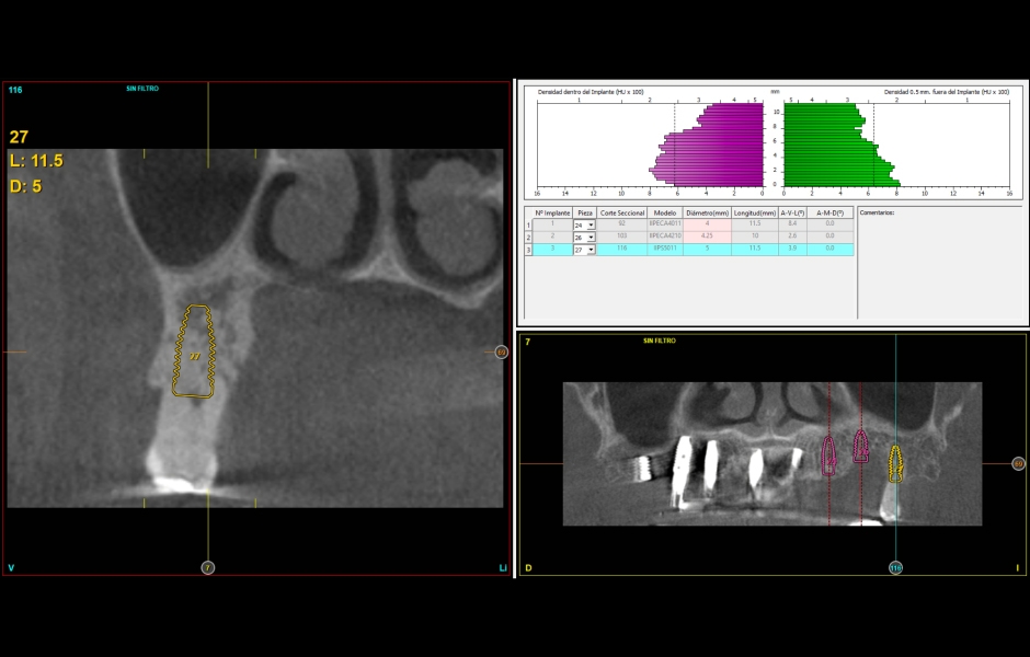 Obr. 10–11: CBCT s návrhem lokalizace implantátů v levém horním kvadrantu. Dostatečný objem kosti umožňuje okamžité zavedení implantátu po extrakci zubu 26. 