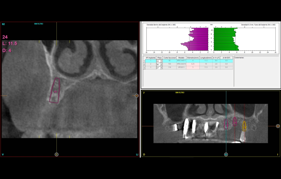 Obr. 10–11: CBCT s návrhem lokalizace implantátů v levém horním kvadrantu. Dostatečný objem kosti umožňuje okamžité zavedení implantátu po extrakci zubu 26. 