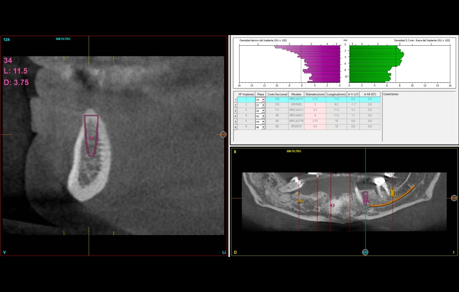 Obr. 12–14: CBCT s návrhem umístění implantátů v dolní čelisti. Stejně jako v horní čelisti budou do frontálního úseku zavedeny úzké implantáty a v laterální oblasti krátké implantáty většího průměru. 