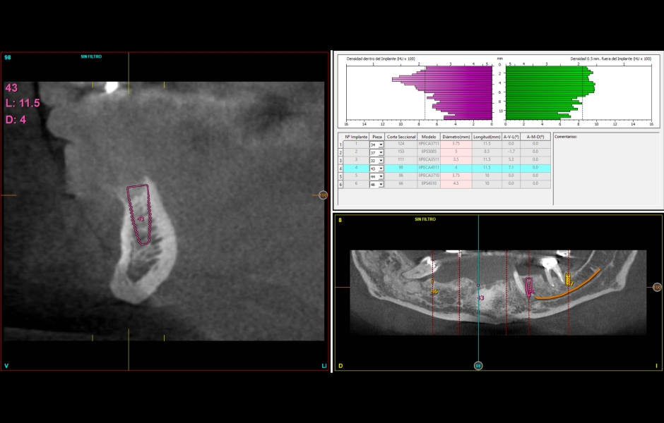 Obr. 12–14: CBCT s návrhem umístění implantátů v dolní čelisti. Stejně jako v horní čelisti budou do frontálního úseku zavedeny úzké implantáty a v laterální oblasti krátké implantáty většího průměru. 