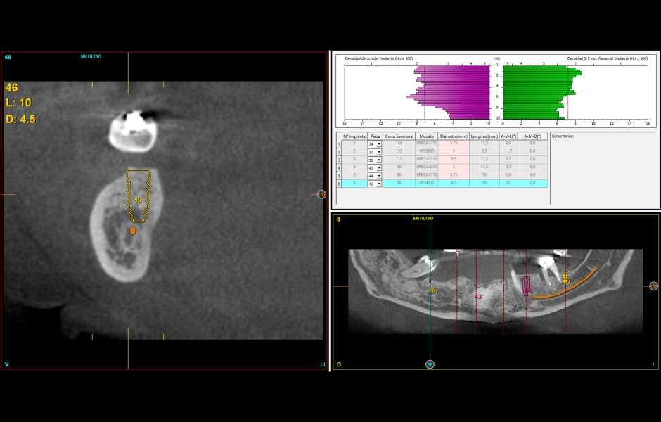 Obr. 12–14: CBCT s návrhem umístění implantátů v dolní čelisti. Stejně jako v horní čelisti budou do frontálního úseku zavedeny úzké implantáty a v laterální oblasti krátké implantáty většího průměru. 