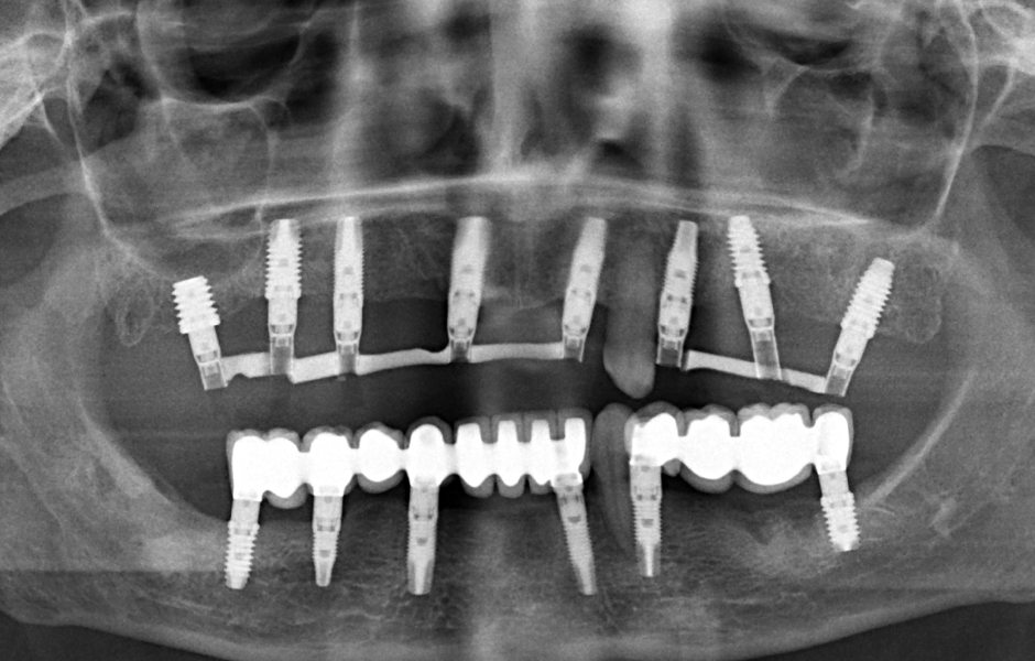 Obr. 16: OPG s nasazenou definitivní metalokeramickou náhradou v dolní čelisti.