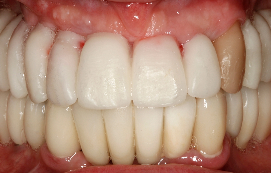 Obr. 17–18: Wax-up náhrady pro horní čelist – zkouška v ústech.