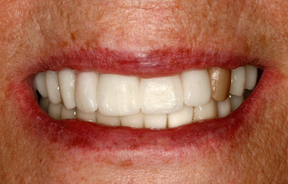 Obr. 17–18: Wax-up náhrady pro horní čelist – zkouška v ústech.