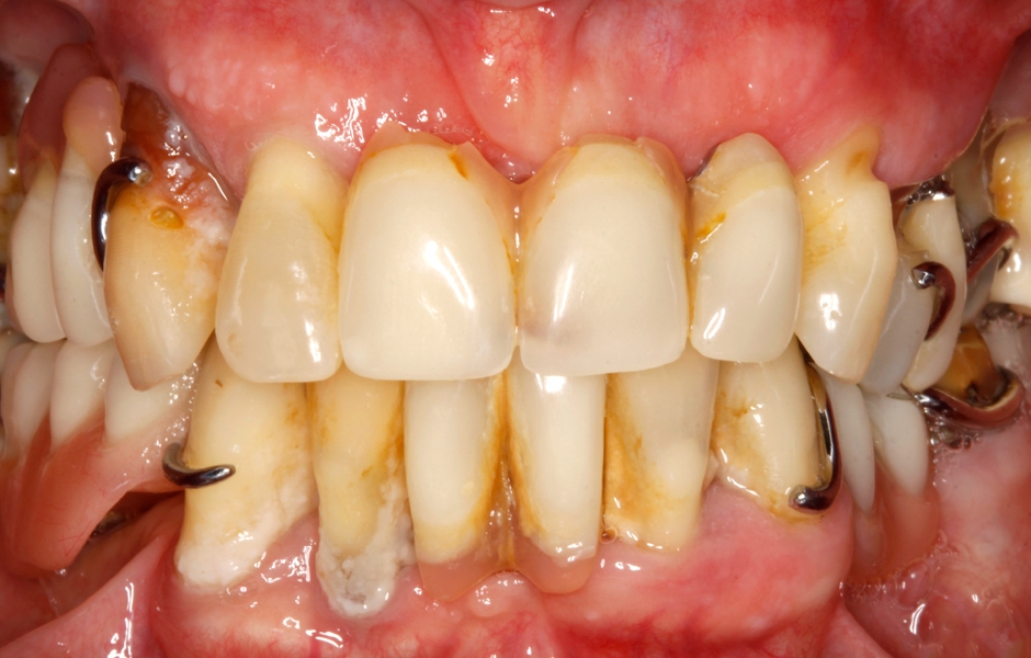 Obr. 2–5: Úvodní fotodokumentace pacientky, na kterých je patrný špatný stav snímatelné náhrady, u zbývajících zubů vidíme ztrátu kosti, obnažené kořeny, nánosy zubního kamene a plaku.