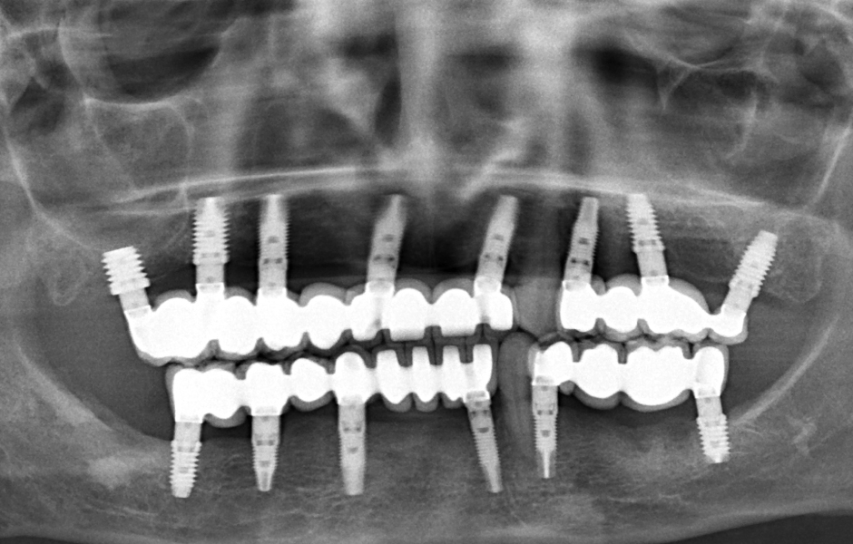 Obr. 20: OPG po nasazení definitivních náhrad se zachovanými zuby 23 a 33.